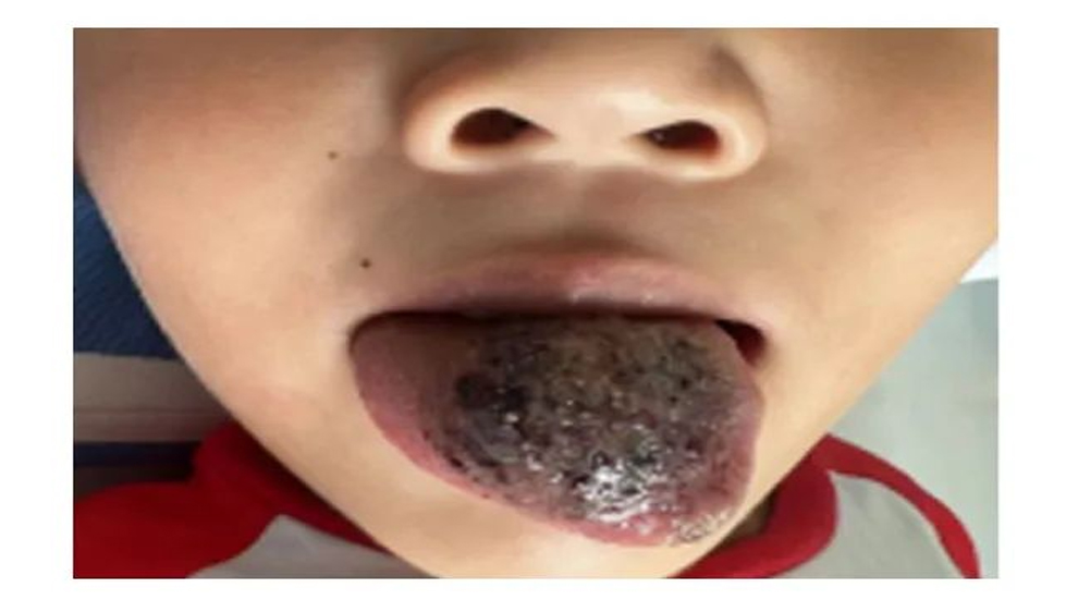 舌部血管淋巴管瘤的微创治疗